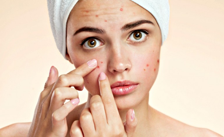 maneras de quitar el acné