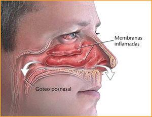 diagrama congestion nasal